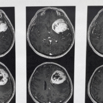 ISSSTE retira tumor cerebral con técnica de paciente despierto en el CMN “20 de Noviembre”